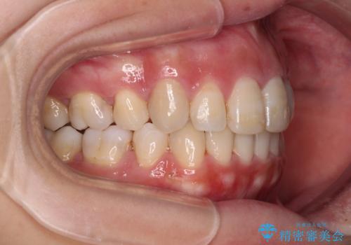 突出した口元が気になる ハーフリンガル装置による抜歯矯正の治療後