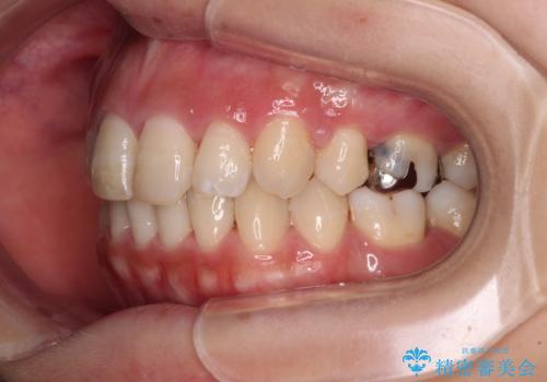 突出した口元が気になる ハーフリンガル装置による抜歯矯正の治療後