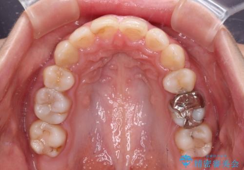 突出した口元が気になる ハーフリンガル装置による抜歯矯正の治療後