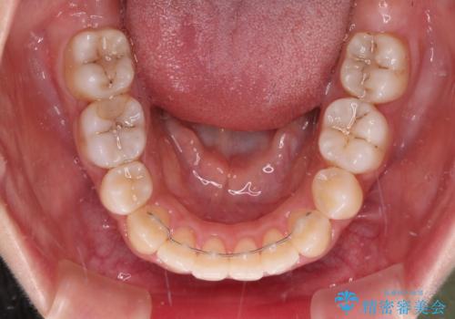 突出した口元が気になる ハーフリンガル装置による抜歯矯正の治療後