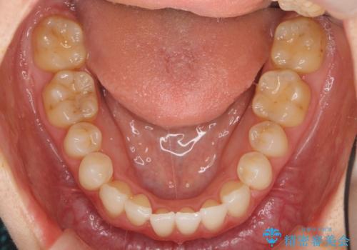 [ インビザライン矯正 ]  マウスピース矯正で治す、前歯のガタつきの治療後