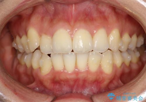 前歯が前後反対にかんでいる インビザラインによる目立たない矯正の治療中