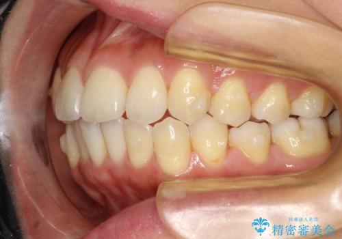 前歯が前後反対にかんでいる インビザラインによる目立たない矯正の治療中