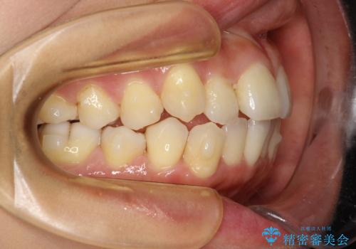 前歯が前後反対にかんでいる　インビザラインによる目立たない矯正の治療中