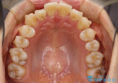 前歯が前後反対にかんでいる インビザラインによる目立たない矯正の治療中