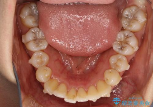 前歯が前後反対にかんでいる インビザラインによる目立たない矯正の治療中