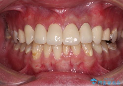むし歯だらけの前歯をきれいにしたい オールセラミッククラウンによる審美歯科治療の治療後