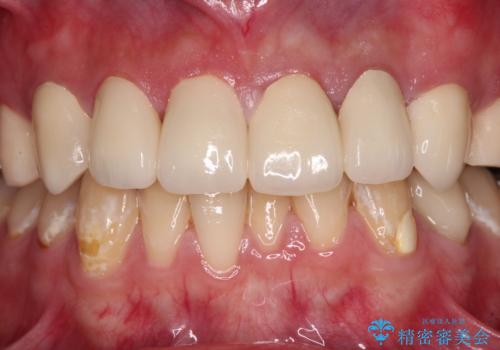 むし歯だらけの前歯をきれいにしたい オールセラミッククラウンによる審美歯科治療の治療後