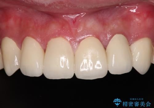 むし歯だらけの前歯をきれいにしたい オールセラミッククラウンによる審美歯科治療