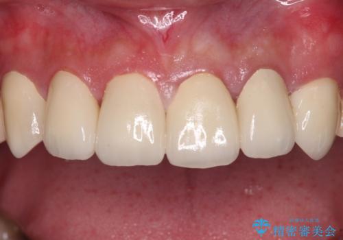 むし歯だらけの前歯をきれいにしたい オールセラミッククラウンによる審美歯科治療の治療後