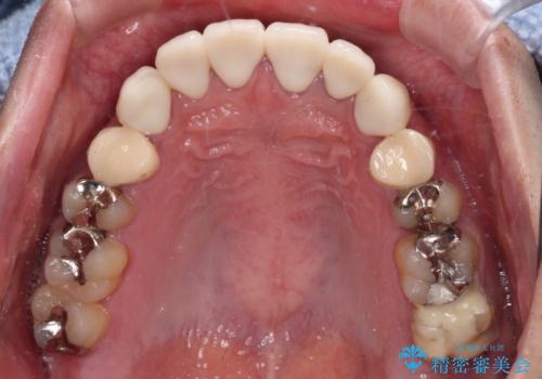 むし歯だらけの前歯をきれいにしたい　オールセラミッククラウンによる審美歯科治療の治療後