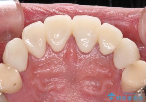 むし歯だらけの前歯をきれいにしたい オールセラミッククラウンによる審美歯科治療の治療後