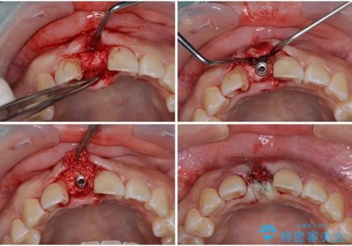 怪我をして不格好な前歯 矯正治療とインプラント補綴治療の治療中