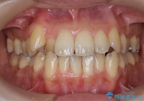 専門的なクリーニング(PMTC)で着色を除去!!の症例 治療前