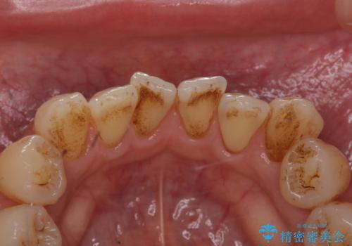 専門的なクリーニング(PMTC)で着色を除去!!の治療前