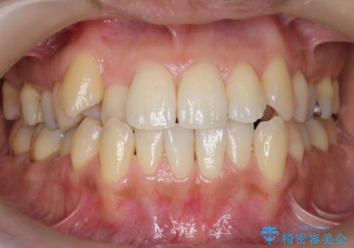 専門的なクリーニング(PMTC)で着色を除去!!の症例 治療後