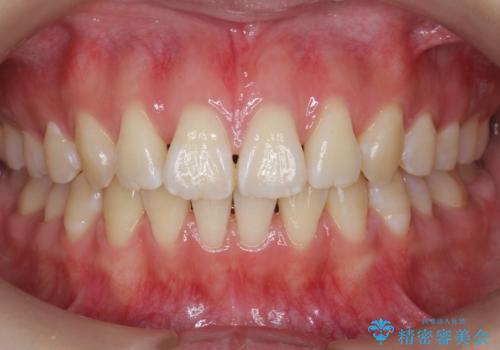 出っ歯 軽度のがたつき インビザラインでの症例 治療後