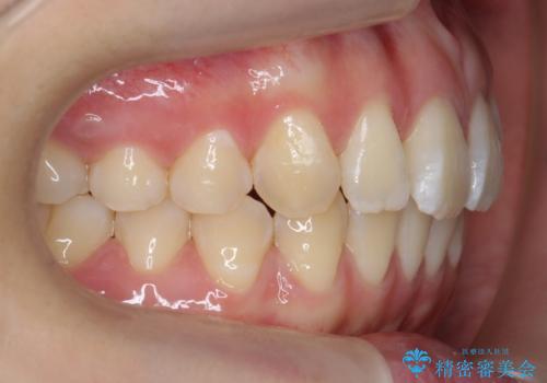 出っ歯 軽度のがたつき インビザラインでの治療後