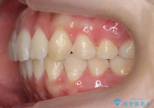 出っ歯 軽度のがたつき インビザラインでの治療後
