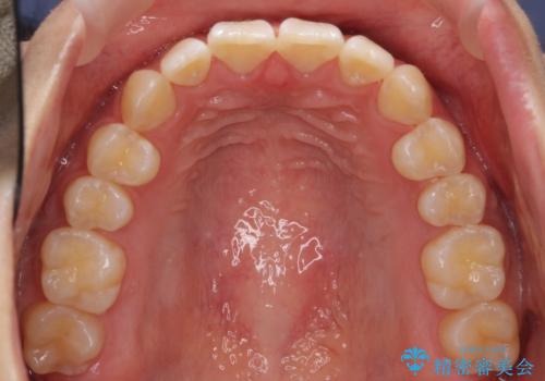 出っ歯 軽度のがたつき インビザラインでの治療後