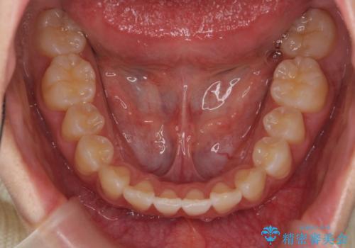 出っ歯 軽度のがたつき インビザラインでの治療後