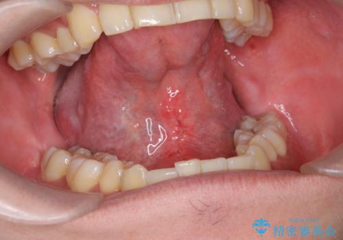 舌小帯の形成で達成する滑舌の改善の治療後