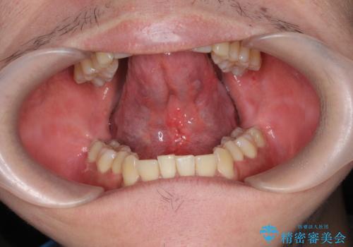 舌小帯の形成で達成する滑舌の改善の治療後