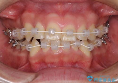 前歯のデコボコを短期間で解消　ワイヤー装置による抜歯矯正の治療中