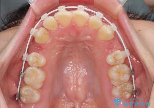 前歯のデコボコを短期間で解消　ワイヤー装置による抜歯矯正の治療中