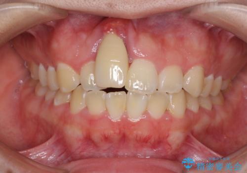 怪我をして不格好な前歯 矯正治療とインプラント補綴治療の治療前
