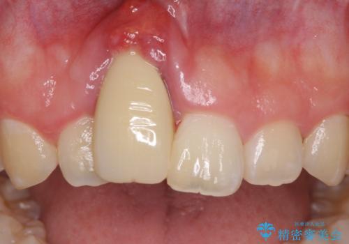 怪我をして不格好な前歯 矯正治療とインプラント補綴治療の症例 治療前