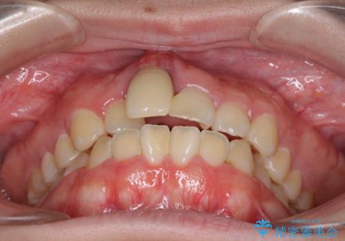 怪我をして不格好な前歯 矯正治療とインプラント補綴治療の治療前