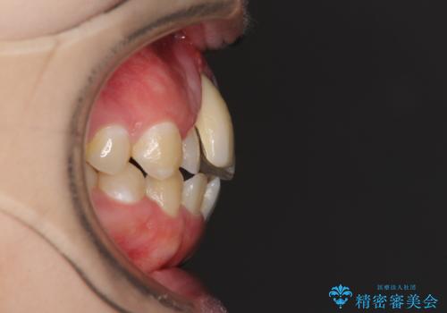 怪我をして不格好な前歯 矯正治療とインプラント補綴治療の治療前