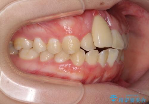 怪我をして不格好な前歯 矯正治療とインプラント補綴治療の治療前