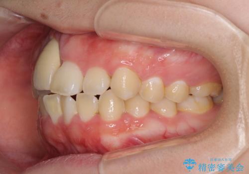 怪我をして不格好な前歯 矯正治療とインプラント補綴治療の治療前