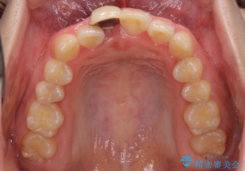 怪我をして不格好な前歯 矯正治療とインプラント補綴治療の治療前