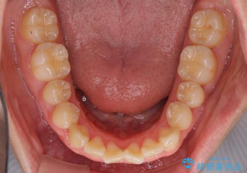 怪我をして不格好な前歯 矯正治療とインプラント補綴治療の治療前