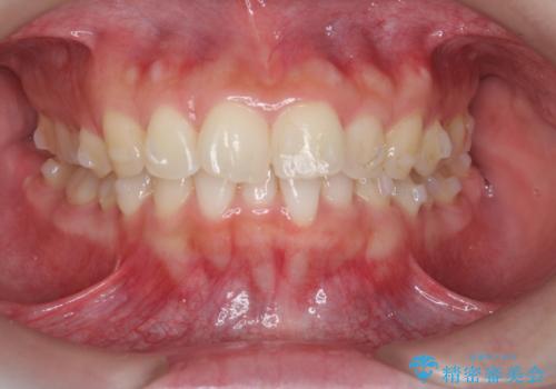 マウスピース 狭窄歯列の改善の治療中