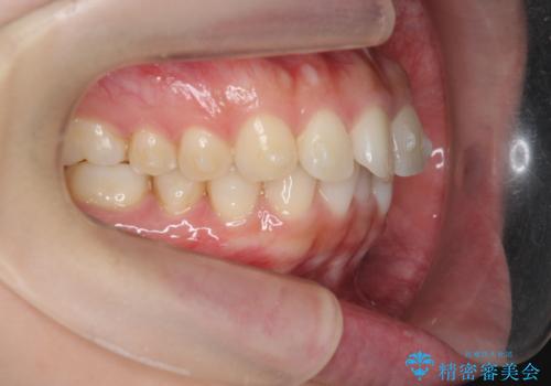 マウスピース 狭窄歯列の改善の治療中