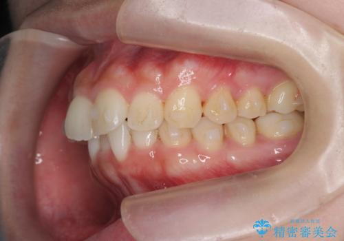 マウスピース 狭窄歯列の改善の治療中