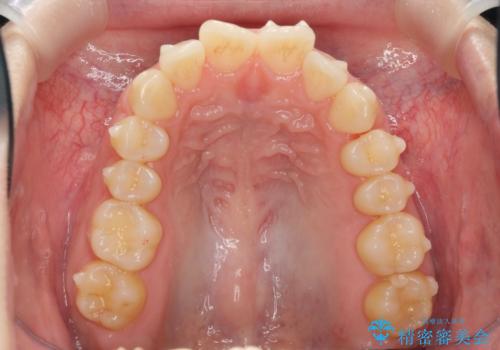 マウスピース 狭窄歯列の改善の治療中