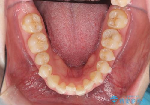 マウスピース 狭窄歯列の改善の治療中