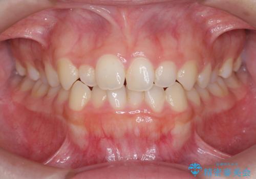 前歯のガタつきを改善　マウスピース矯正とワイヤー部分矯正の症例 治療前