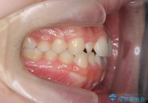 前歯のガタつきを改善　マウスピース矯正とワイヤー部分矯正の治療前
