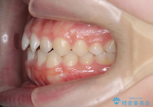 前歯のガタつきを改善　マウスピース矯正とワイヤー部分矯正の治療前