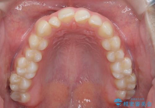 前歯のガタつきを改善　マウスピース矯正とワイヤー部分矯正の治療前