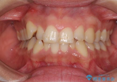 前歯のデコボコを短期間で解消　ワイヤー装置による抜歯矯正の症例 治療前