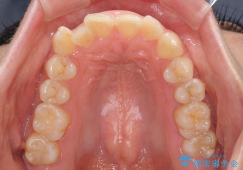 前歯のデコボコを短期間で解消　ワイヤー装置による抜歯矯正の治療前