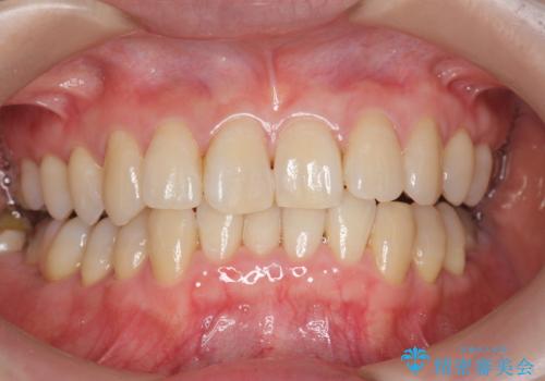 オフィスホワイトニングで、1日で白い歯に!!の症例 治療前