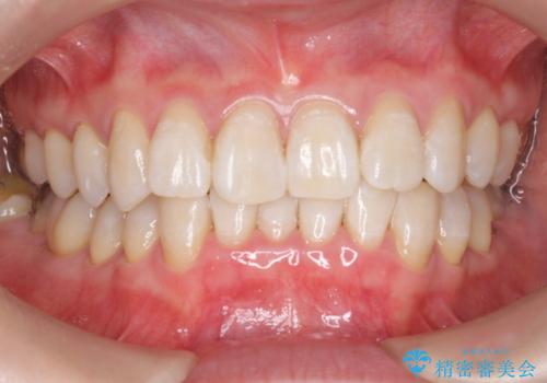 オフィスホワイトニングで、1日で白い歯に!!